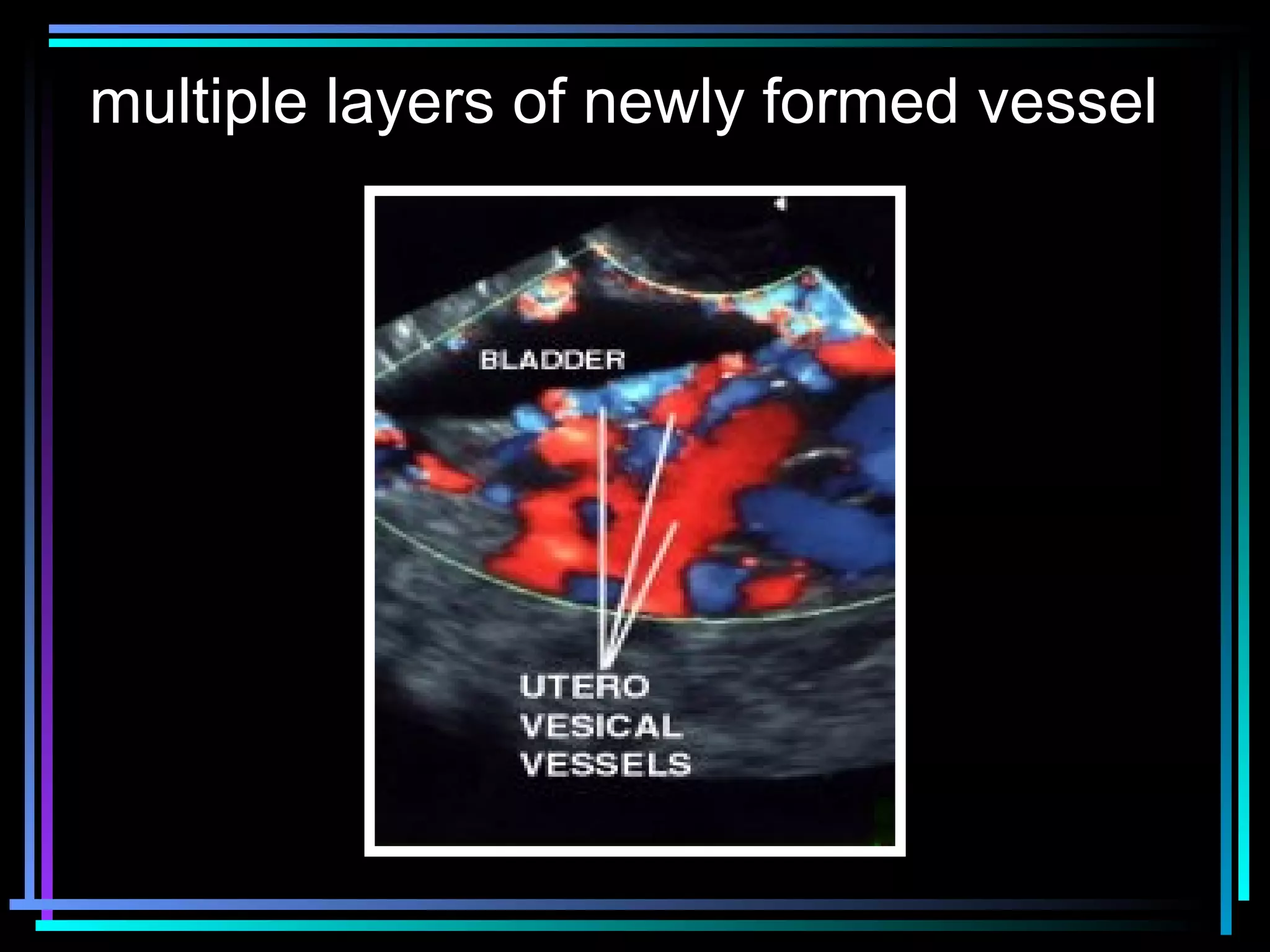 31
multiple layers of newly formed vessel
 