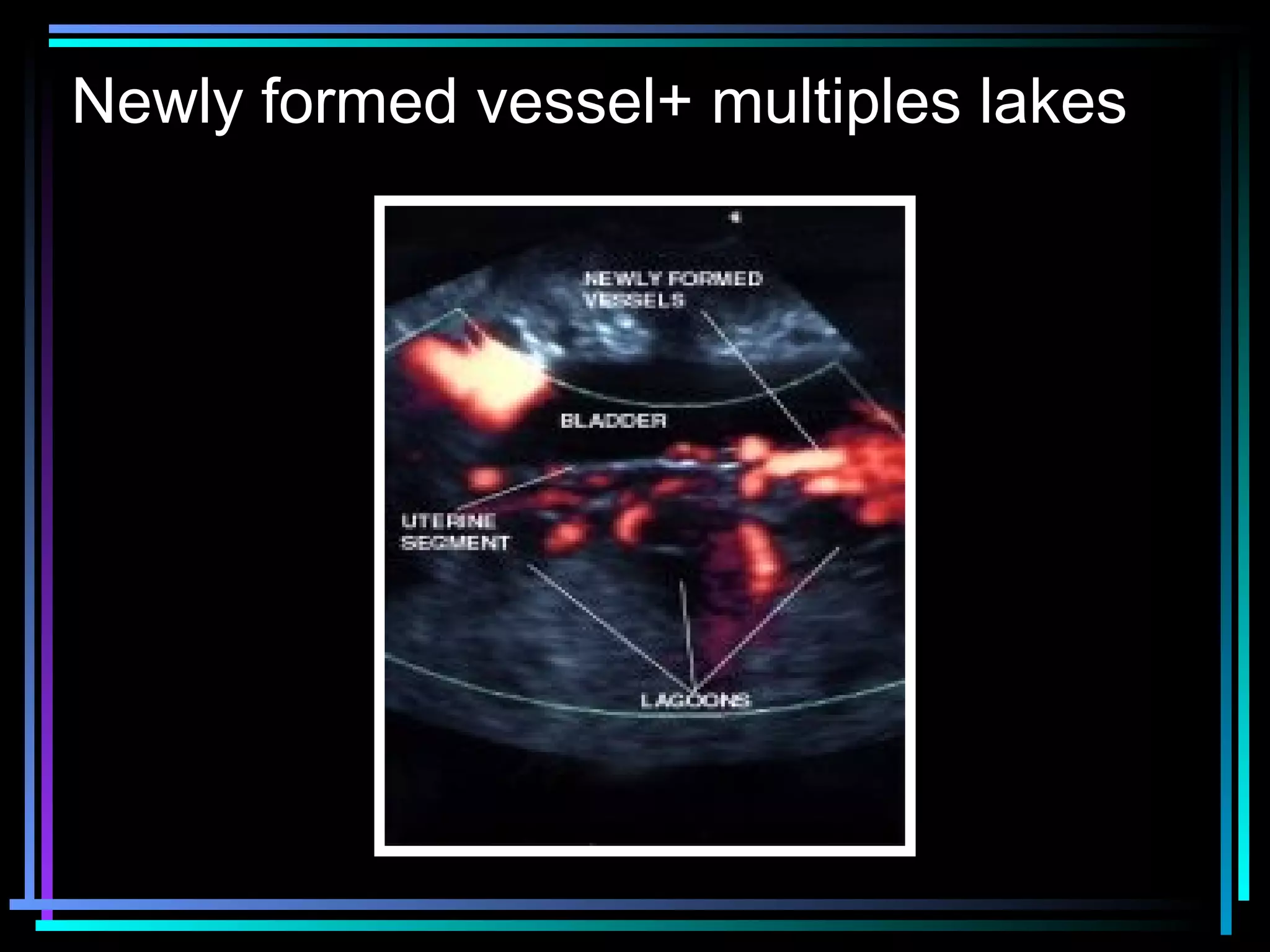 32
Newly formed vessel+ multiples lakes
 