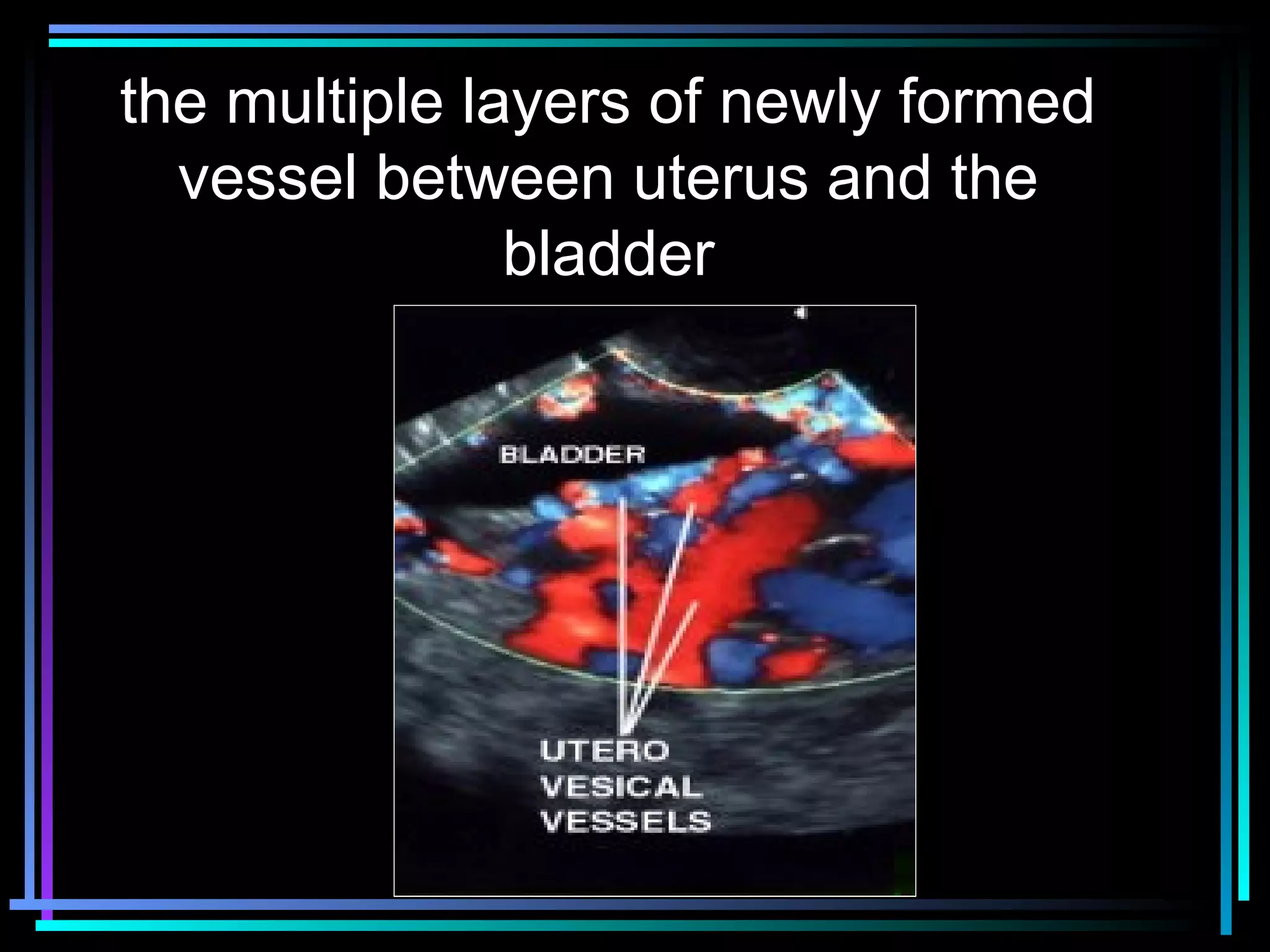 33
the multiple layers of newly formed
vessel between uterus and the
bladder
 