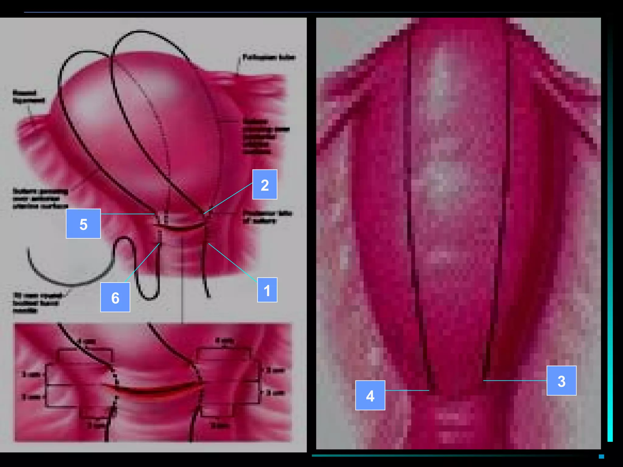 47
Lynch suture B-
1
2
3
4
5
6
 