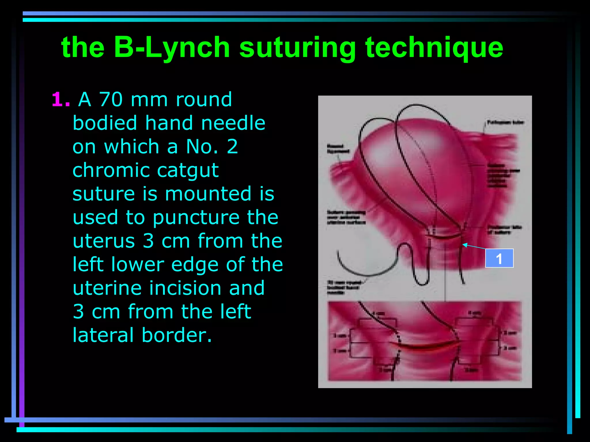 50
the B-Lynch suturing technique
1. A 70 mm round
bodied hand needle
on which a No. 2
chromic catgut
suture is mounted is
used to puncture the
uterus 3 cm from the
left lower edge of the
uterine incision and
3 cm from the left
lateral border.
1
 