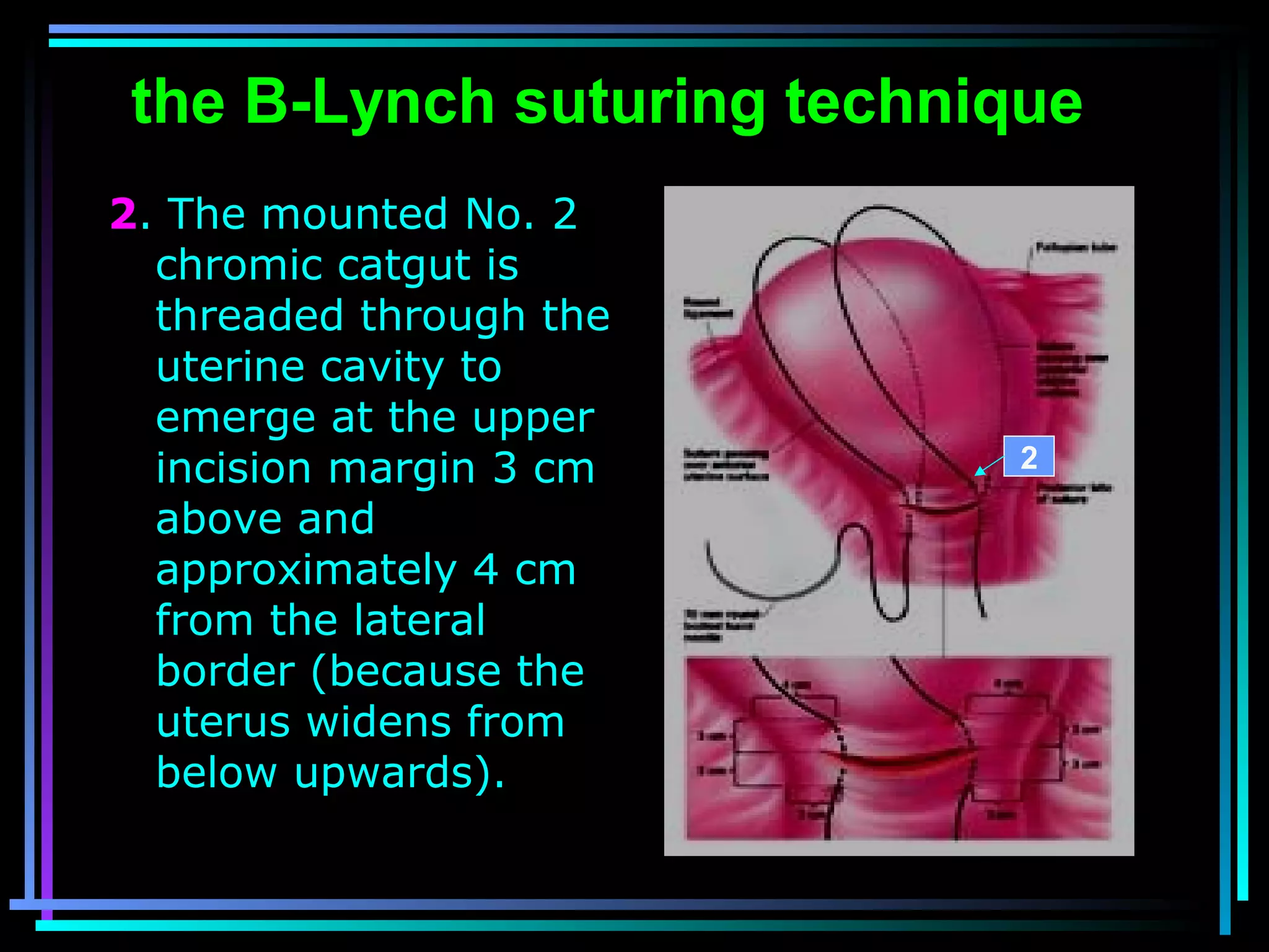 51
the B-Lynch suturing technique
2. The mounted No. 2
chromic catgut is
threaded through the
uterine cavity to
emerge at the upper
incision margin 3 cm
above and
approximately 4 cm
from the lateral
border (because the
uterus widens from
below upwards).
2
 