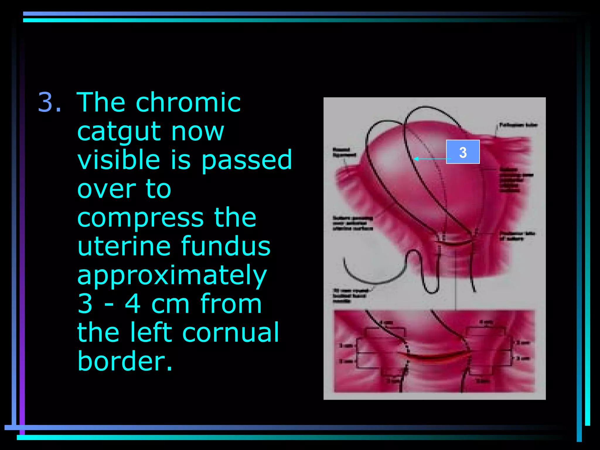 52
3. The chromic
catgut now
visible is passed
over to
compress the
uterine fundus
approximately
3 - 4 cm from
the left cornual
border.
3
 