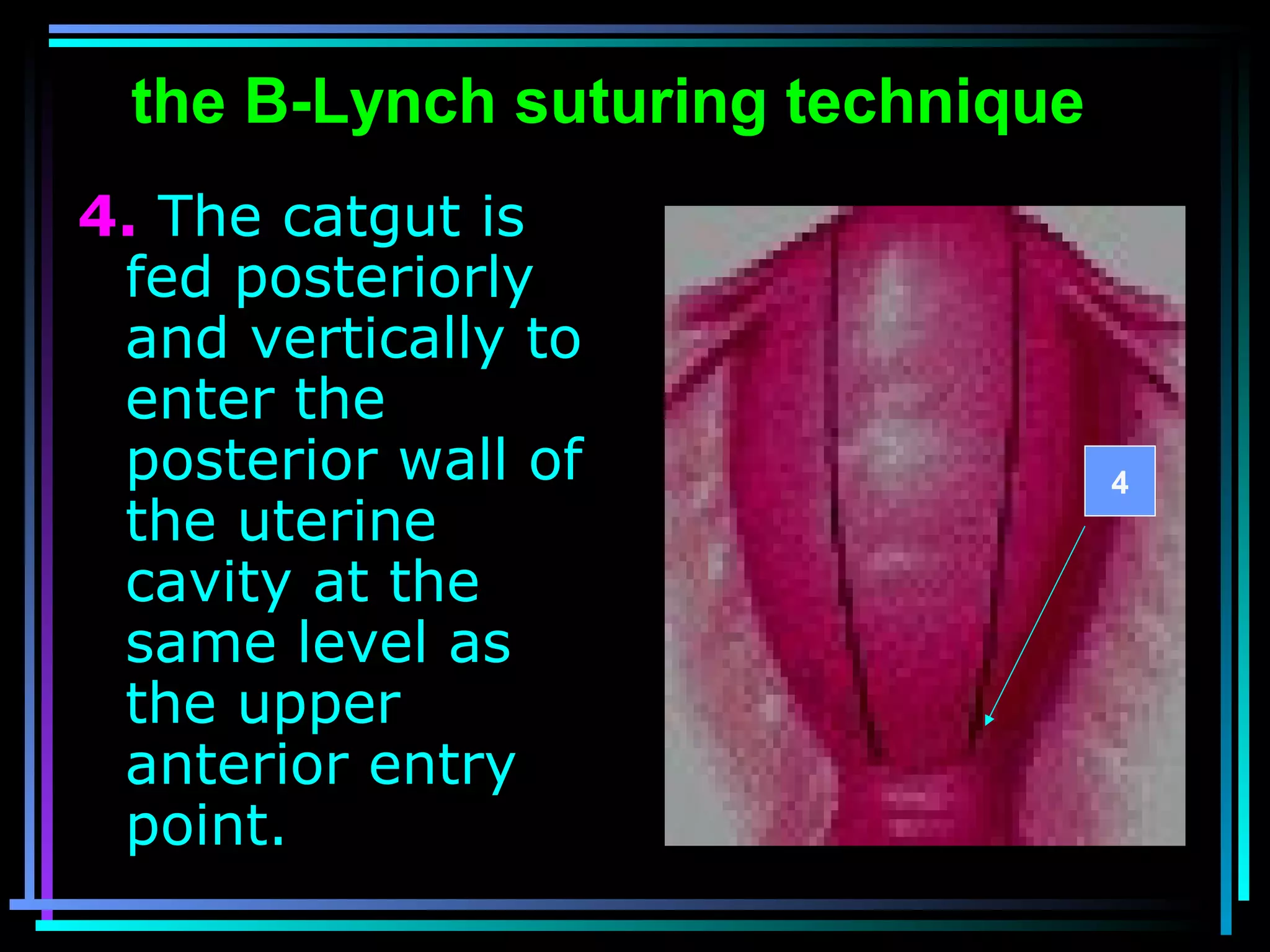 53
the B-Lynch suturing technique
4. The catgut is
fed posteriorly
and vertically to
enter the
posterior wall of
the uterine
cavity at the
same level as
the upper
anterior entry
point.
4
 