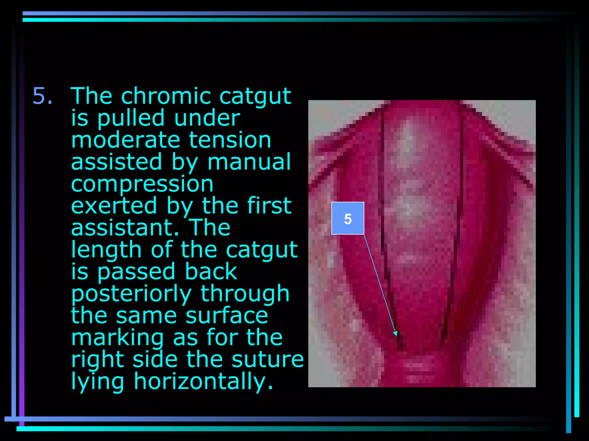 54
5. The chromic catgut
is pulled under
moderate tension
assisted by manual
compression
exerted by the first
assistant. The
length of the catgut
is passed back
posteriorly through
the same surface
marking as for the
right side the suture
lying horizontally.
5
 