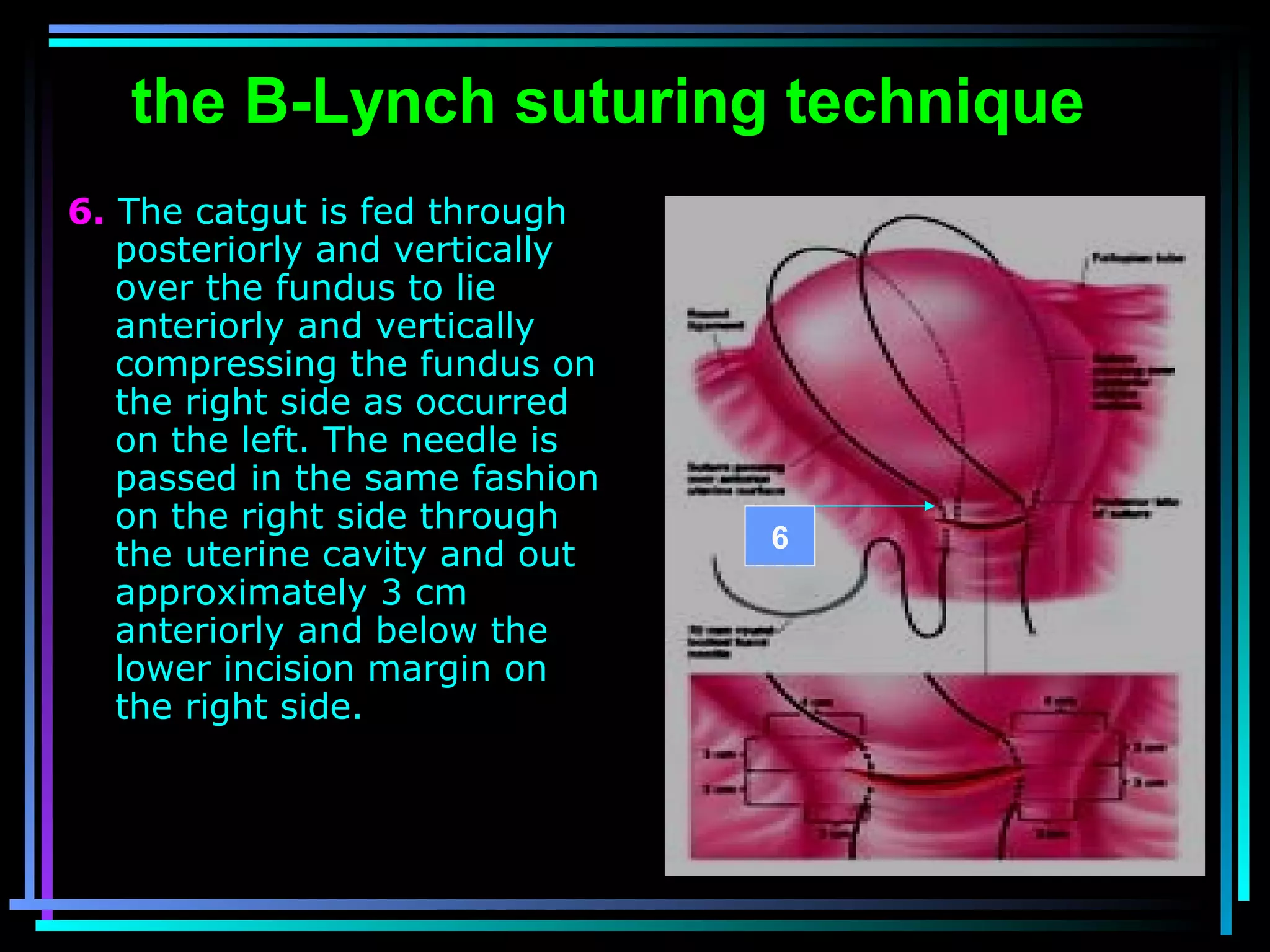 55
the B-Lynch suturing technique
6. The catgut is fed through
posteriorly and vertically
over the fundus to lie
anteriorly and vertically
compressing the fundus on
the right side as occurred
on the left. The needle is
passed in the same fashion
on the right side through
the uterine cavity and out
approximately 3 cm
anteriorly and below the
lower incision margin on
the right side.
6
 