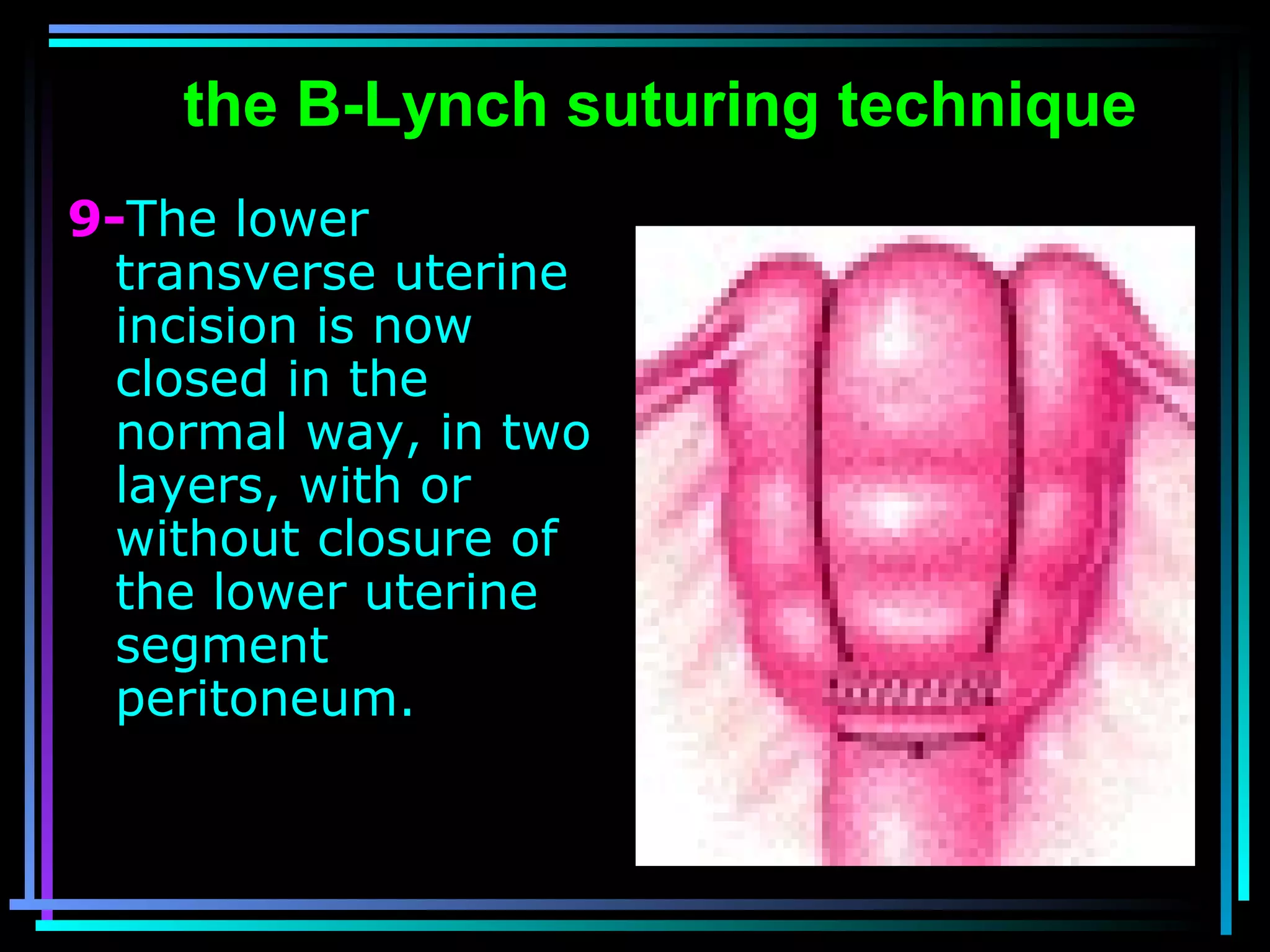 58
9-The lower
transverse uterine
incision is now
closed in the
normal way, in two
layers, with or
without closure of
the lower uterine
segment
peritoneum.
the B-Lynch suturing technique
 