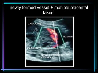 28
newly formed vessel + multiple placental
lakes
 