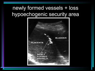 29
newly formed vessels + loss
hypoechogenic security area
 
