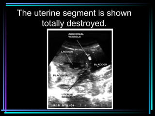 30
The uterine segment is shown
totally destroyed.
 
