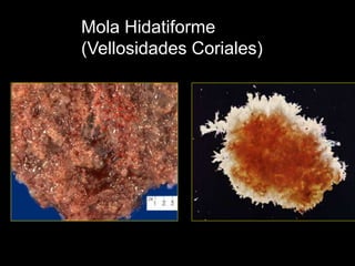 Mola Hidatiforme
(Vellosidades Coriales)
 