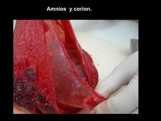 Amnios y corion.
 