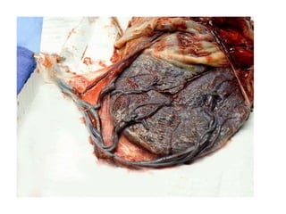 placenta%20MD.pptx