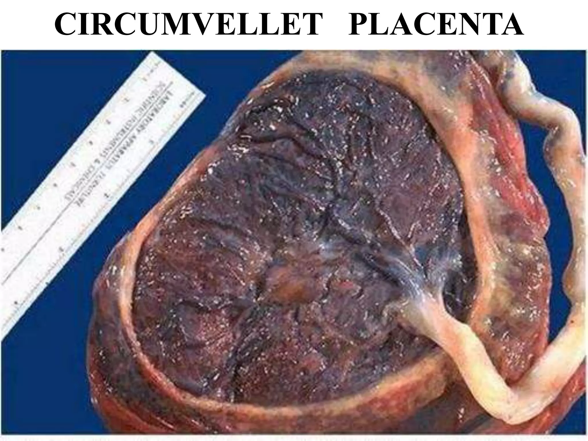CIRCUMVELLET PLACENTA
 