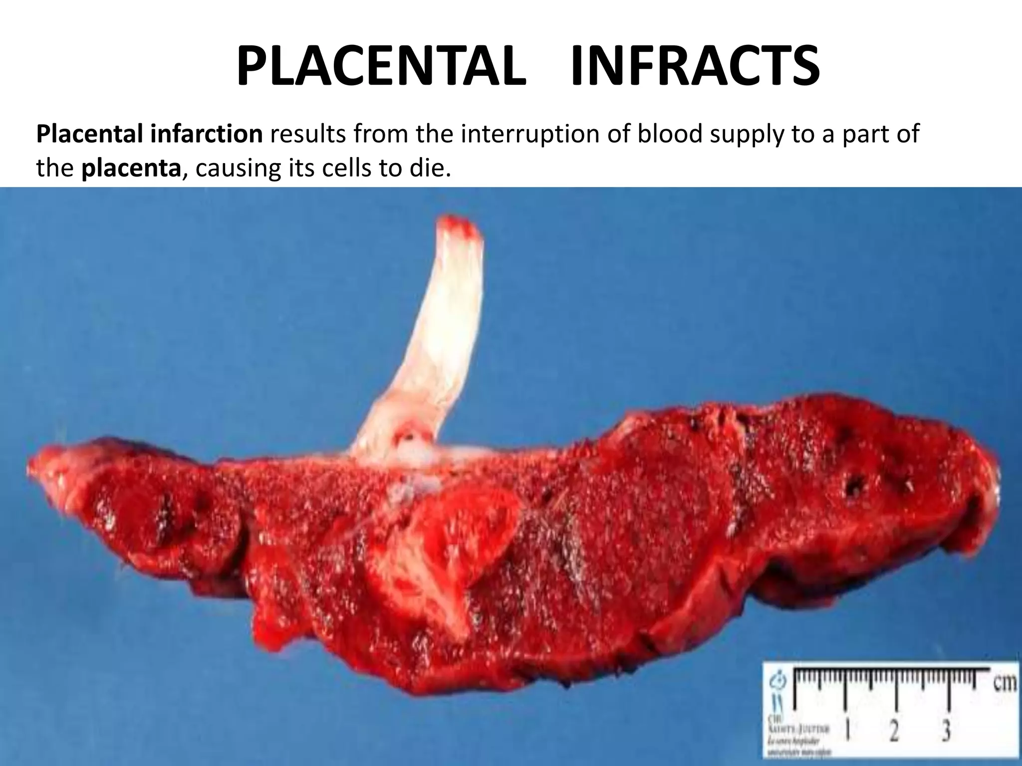 Placenta Abnormalities Pptx Placenta Abnormalities Pptx