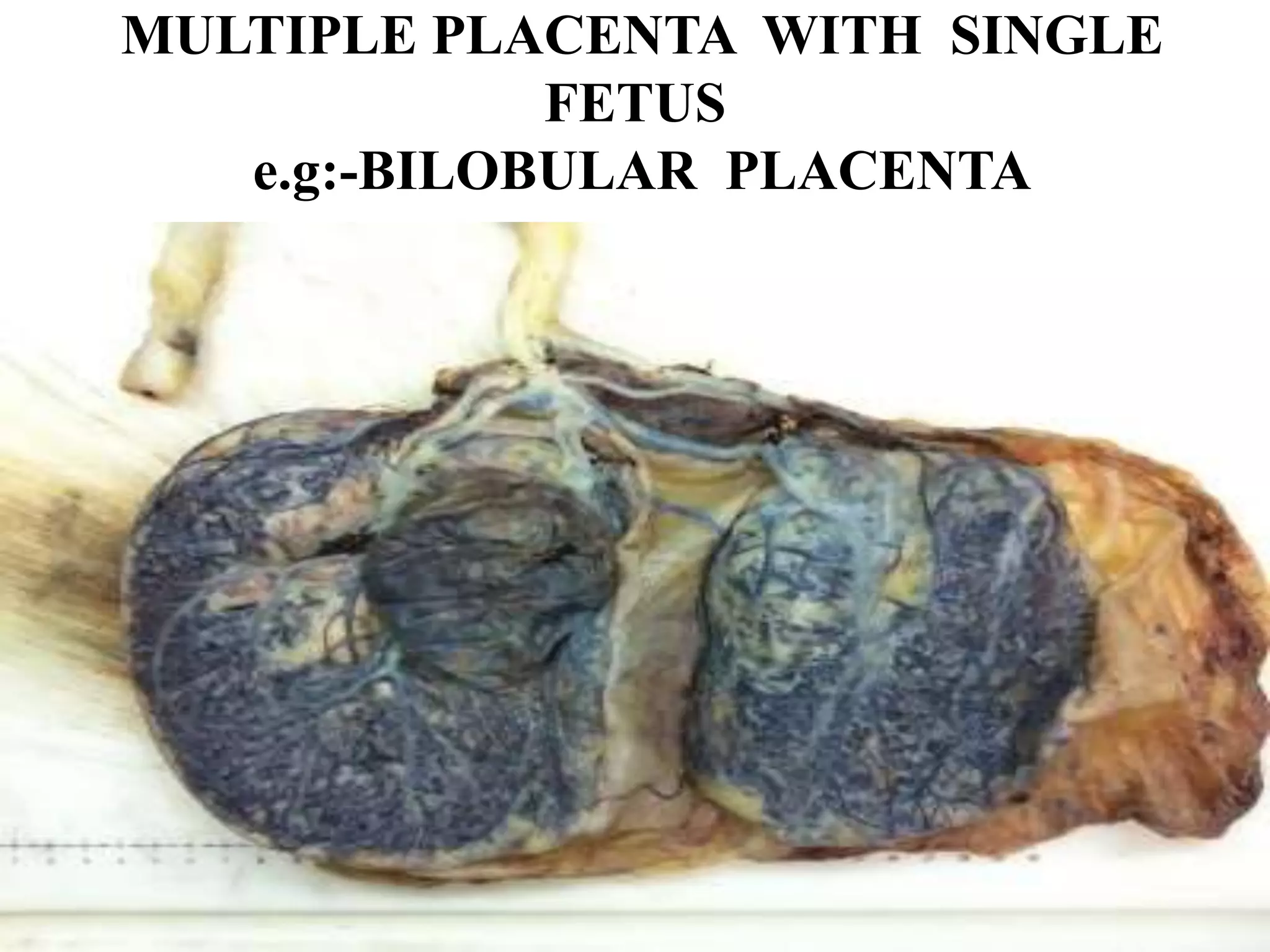 MULTIPLE PLACENTA WITH SINGLE
FETUS
e.g:-BILOBULAR PLACENTA
 
