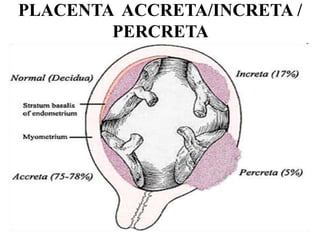 PLACENTA ACCRETA/INCRETA /
PERCRETA
 