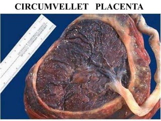 CIRCUMVELLET PLACENTA
 