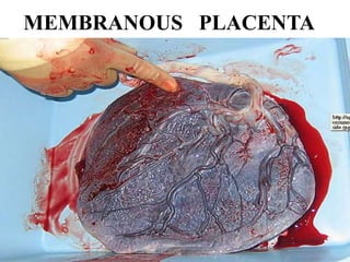 MEMBRANOUS PLACENTA
 