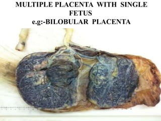 MULTIPLE PLACENTA WITH SINGLE
FETUS
e.g:-BILOBULAR PLACENTA
 