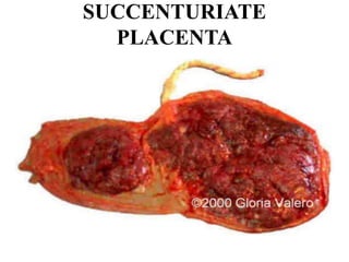 SUCCENTURIATE
PLACENTA
 