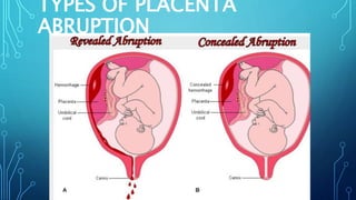 TYPES OF PLACENTA
ABRUPTION
 