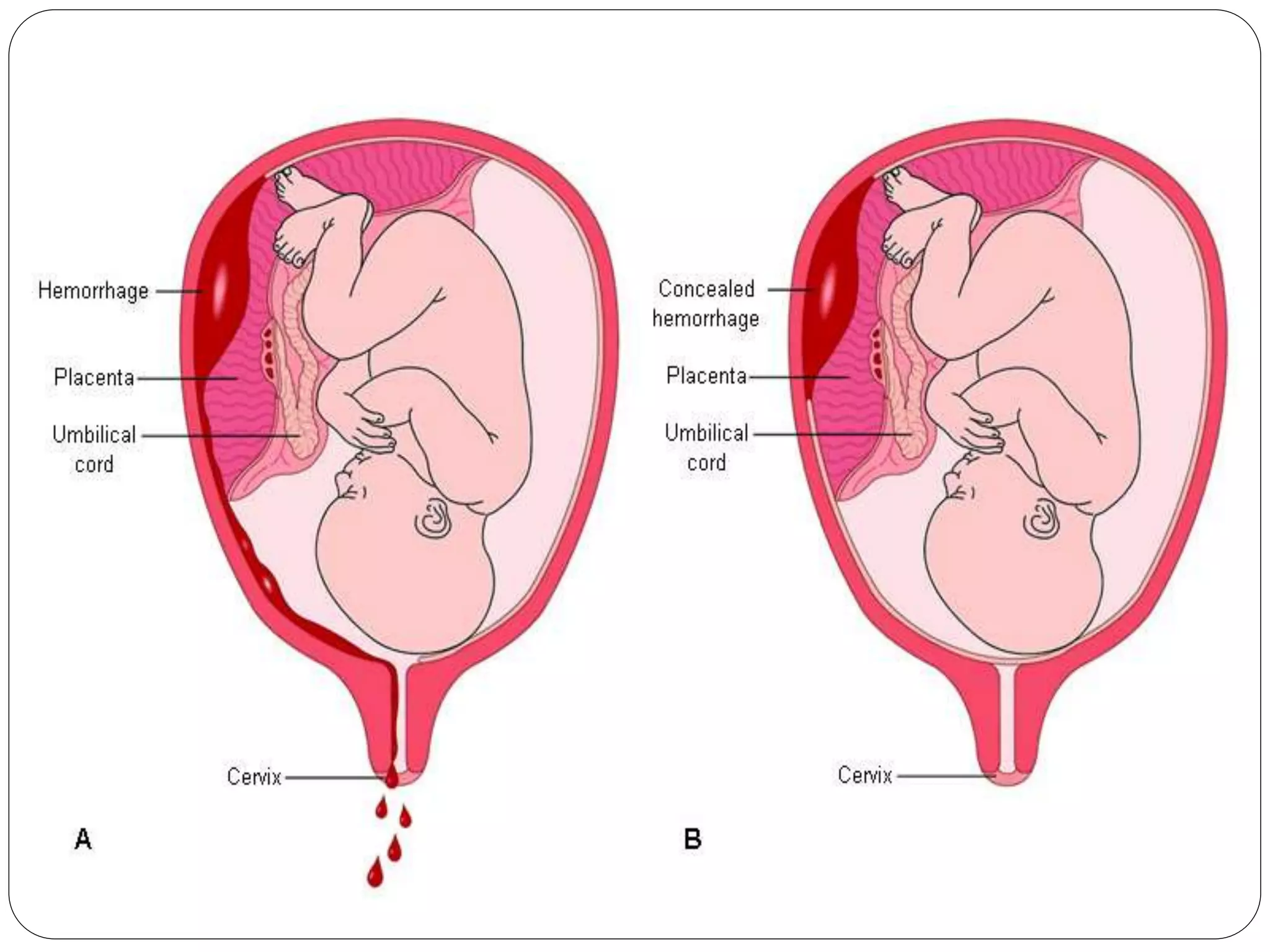Illustration of Diy Placenta Abruption Treatment