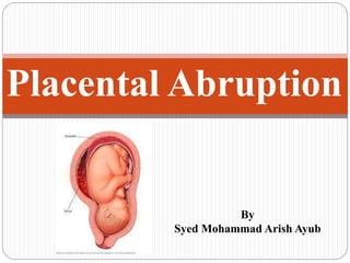 Placental Abruption
By
Syed Mohammad Arish Ayub
 
