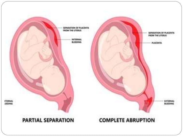 Picture of Placenta Abruption.pptx