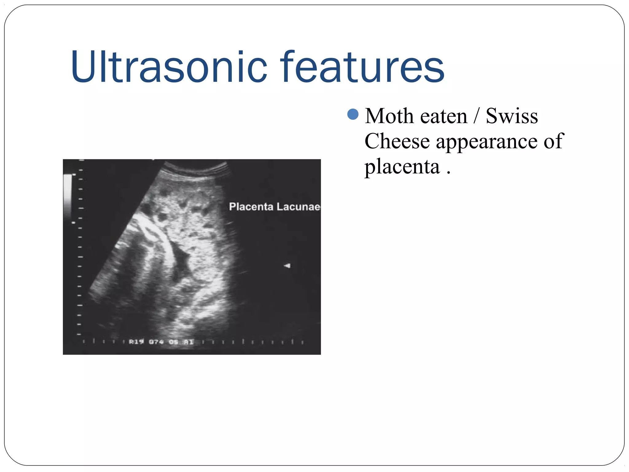 Ultrasonic features
Moth eaten / Swiss

Cheese appearance of
placenta .

 