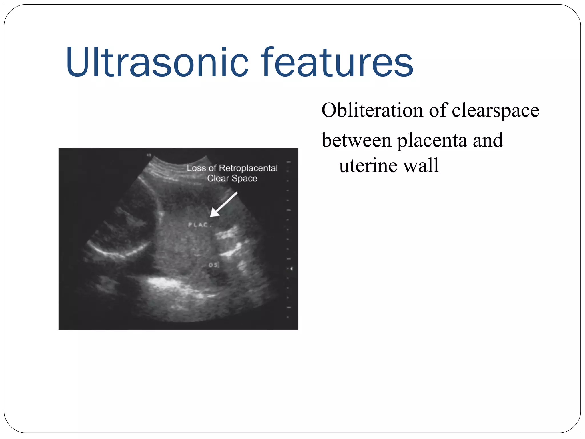 Ultrasonic features
Obliteration of clearspace
between placenta and
uterine wall

 