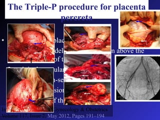 Placenta Accreta For Post Graduate ODP