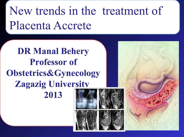 Placenta Accreta For Post Graduate PPT