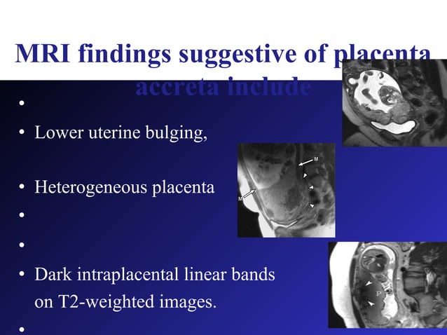 Placenta Accreta For Post Graduate PPT