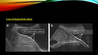 Loss of hypoechoic plane
 