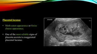 Placental lacunae
• Moth-eaten appearance or Swiss
cheese appearance.
• One of the most reliable signs of
placenta accreta is exaggerated
placental lacunae.
 