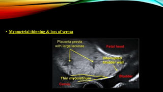 • Myometrial thinning & loss of serosa
 