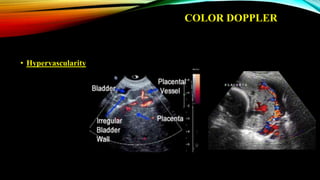 COLOR DOPPLER
• Hypervascularity
 