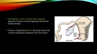 • 2nd ligature- utero ovarian artery ligation
junction of utero-ovarian ligament and lateral
uterine border.
• Artery is ligated just below the point where the
ovarian suspensory ligament joins the uterus.
 