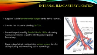 INTERNAL ILIAC ARTERY LIGATION
• Requires skill in retroperitoneal surgery at the pelvic sidewall.
• Success rate to control bleeding 50-75%.
• It was first performed by Burchell in the 1960s after doing
various experiments to control bleeding in postpartum
hemorrhage.
• It converts pelvic circulation into a venous system, thereby
aiding clotting and controlling pelvic hemorrhage.
 