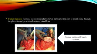 • Uterus incision: classical incision is preferred over transverse incision to avoid entry through
the placenta and prevent subsequent blood loss.
Classical incision with breech
extraction.
 