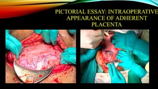 PICTORIAL ESSAY: INTRAOPERATIVE
APPEARANCE OF ADHERENT
PLACENTA
 
