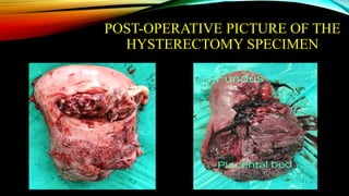 POST-OPERATIVE PICTURE OF THE
HYSTERECTOMY SPECIMEN
 
