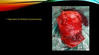 • Specimen of obstetrics hysterectomy.
 