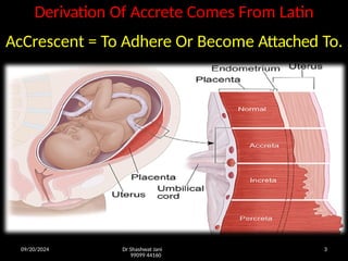 09/20/2024 Dr Shashwat Jani
99099 44160
3
Derivation Of Accrete Comes From Latin
AcCrescent = To Adhere Or Become Attached To.
 