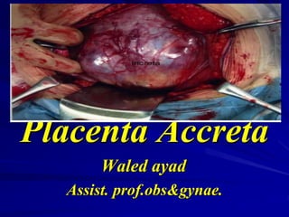 Placenta Accreta
Waled ayad
Assist. prof.obs&gynae.
 