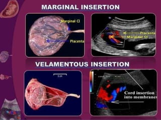 Placenta and Cord Abnormalities .pptx