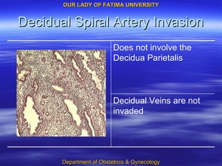 Decidual Spiral Artery Invasion Decidual Veins are not invaded Does not involve the Decidua Parietalis 