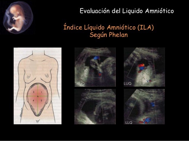 Evaluación de la placenta, cordon umbilical y liquido amniotico