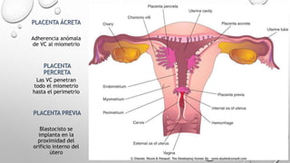 PLACENTA ÁCRETA
PLACENTA
PERCRETA
PLACENTA PREVIA
Adherencia anómala
de VC al miometrio
Las VC penetran
todo el miometrio
hasta el perimetrio
Blastocisto se
implanta en la
proximidad del
orificio interno del
útero
 